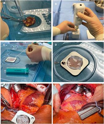 Use of left atrial appendage as an autologous tissue source for epicardial micrograft transplantation during LVAD implantation